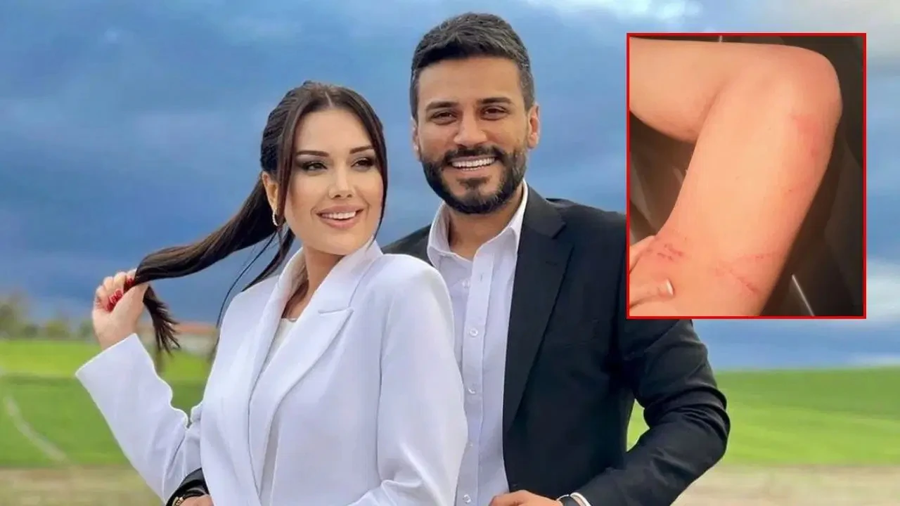 Dilan Polat darp izlerini paylaşıp sildi